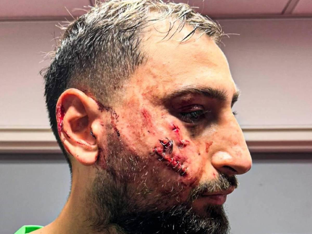 La impactante lesión de Donnaruma que recibió una patada en el rostro y tuvo que ser reemplazado ante Mónaco