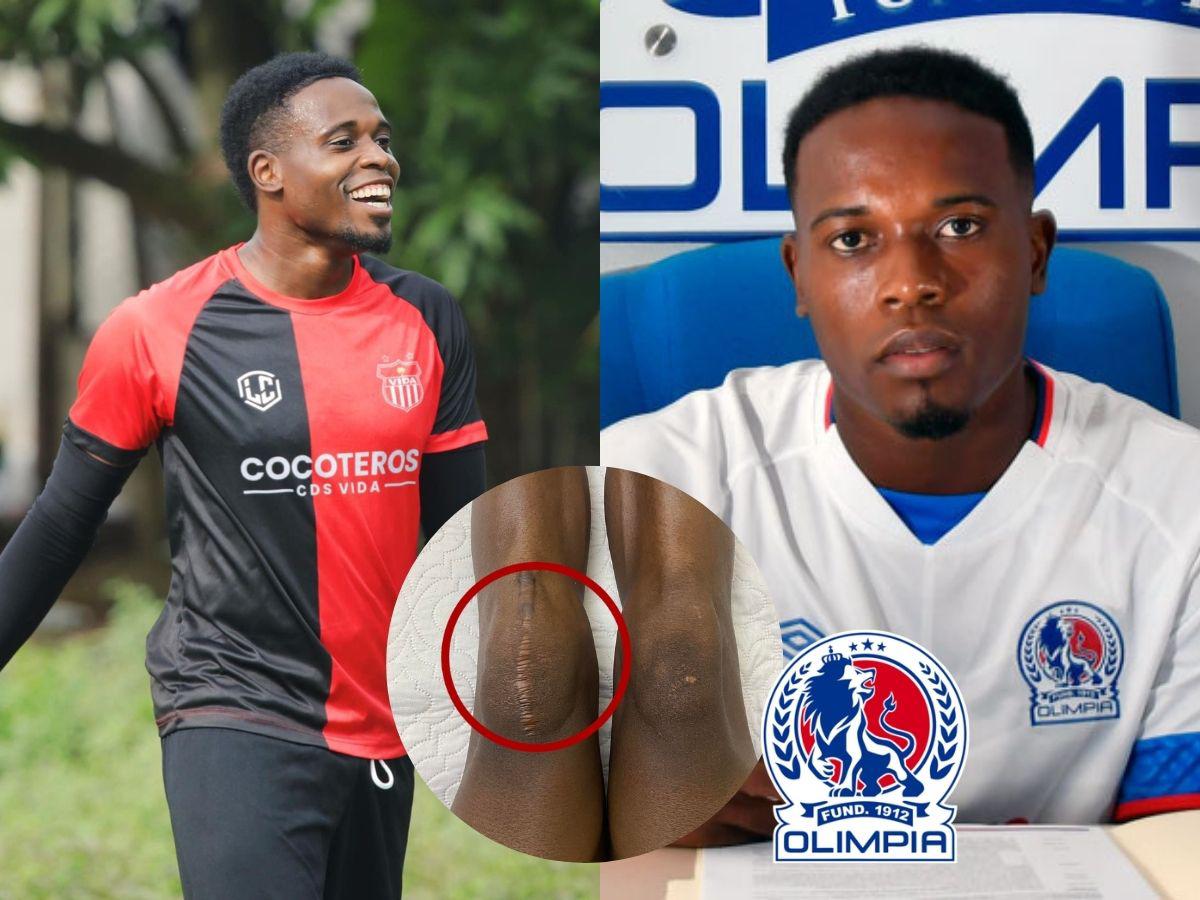 Exjugador de Olimpia revela el viacrucis que vivió por dos años tras sufrir terrible lesión: esta es su realidad
