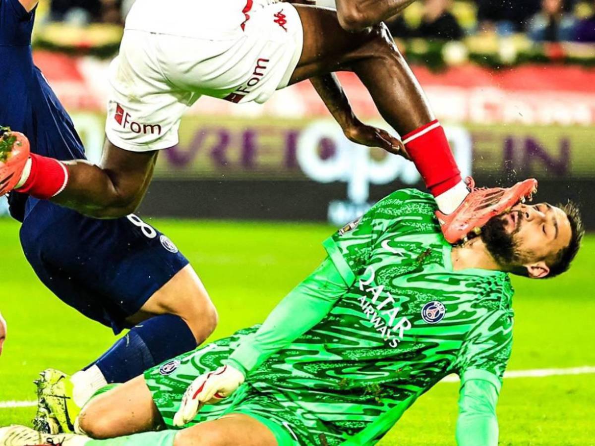 La impactante lesión de Donnaruma que recibió una patada en el rostro y tuvo que ser reemplazado ante Mónaco