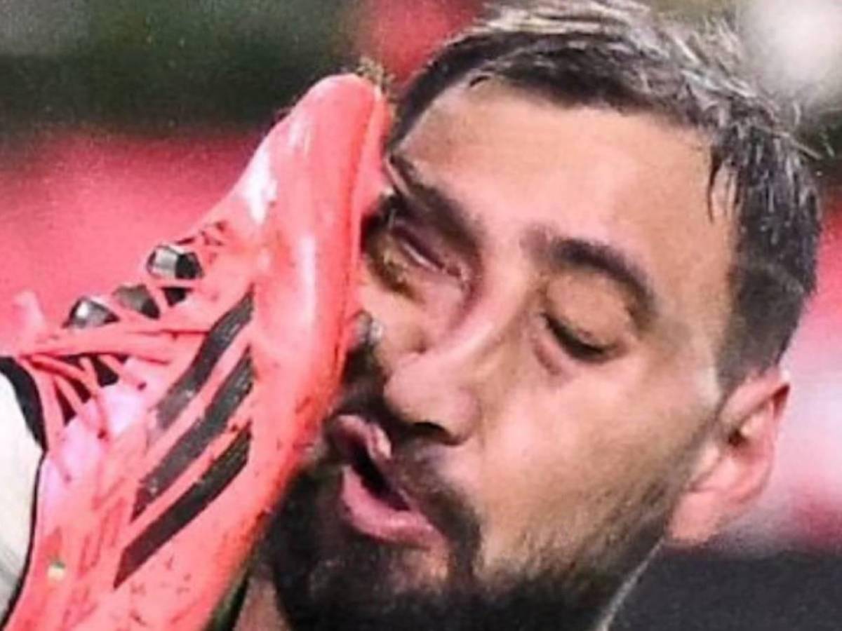 La impactante lesión de Donnaruma que recibió una patada en el rostro y tuvo que ser reemplazado ante Mónaco