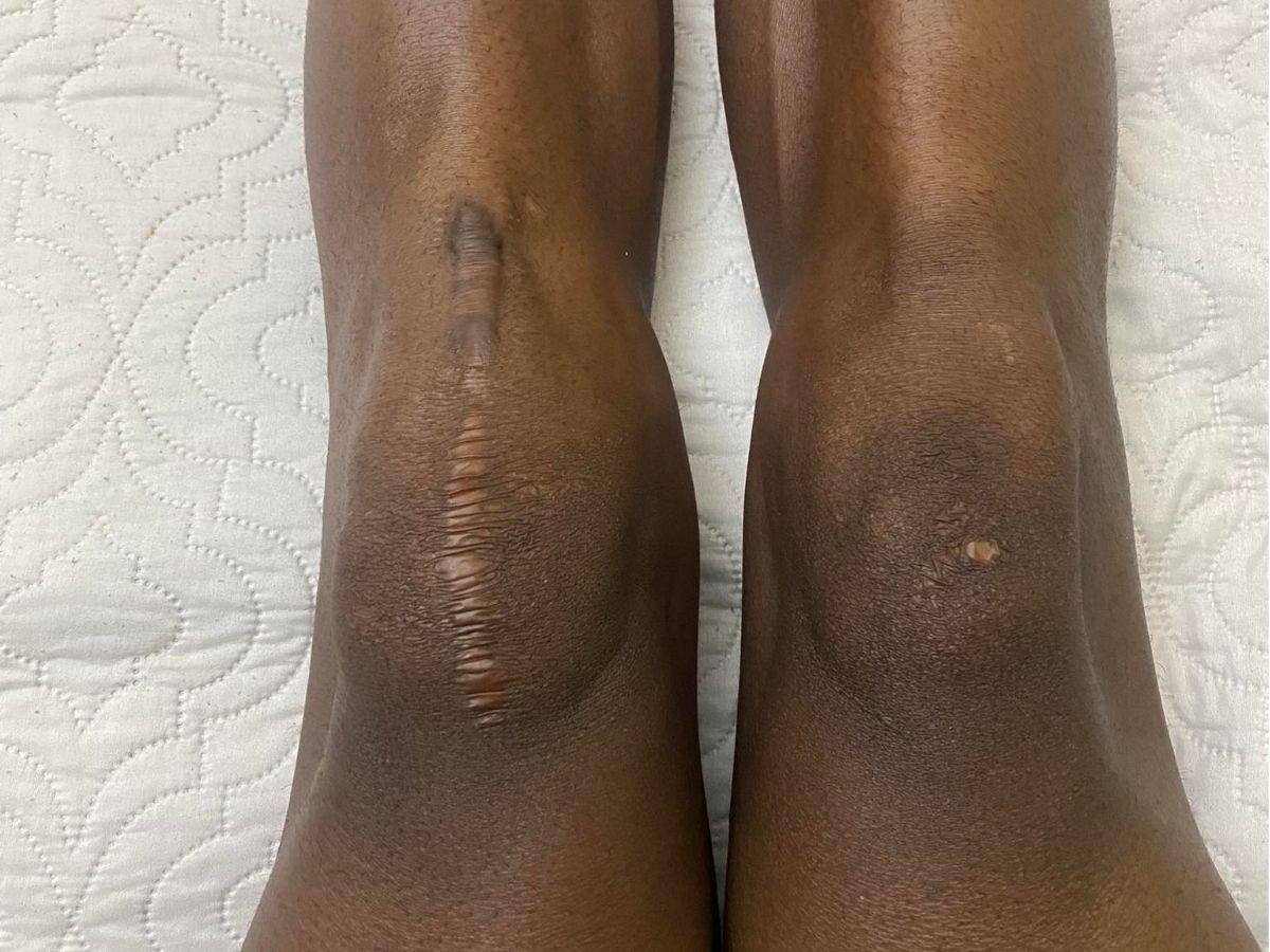 Exjugador de Olimpia revela el viacrucis que vivió por dos años tras sufrir terrible lesión: esta es su realidad