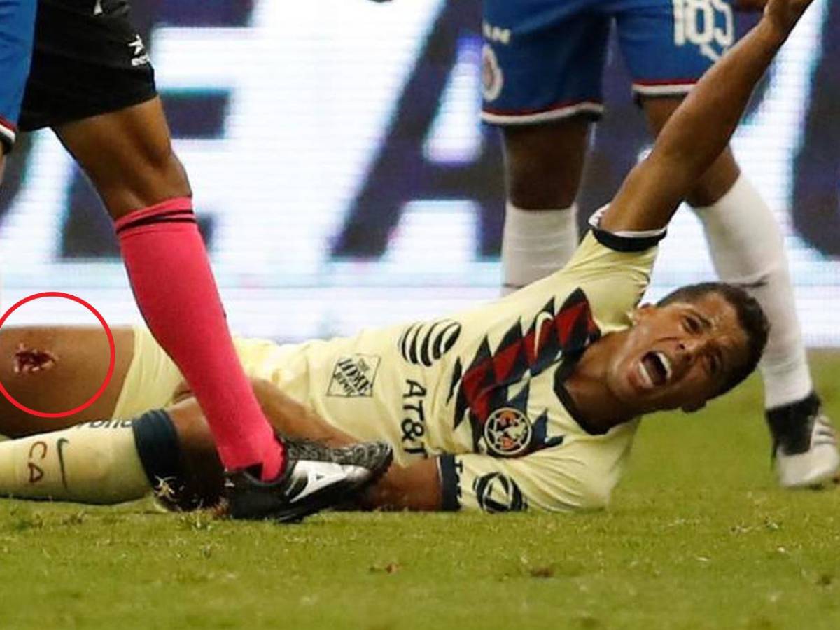 Romario se suma: sufrieron las lesiones más escalofriantes en el fútbol