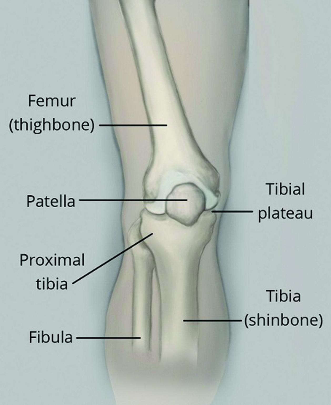 Esta molestia significa que la sobrecarga de actividad física causó un trauma en el hueso y una grieta en el hueso del tercio proximal de la tibia.
