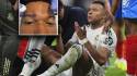 Mbappé muestra como quedó su rostro tras sufrir una agresión: Los tres puntos de la vergüenza