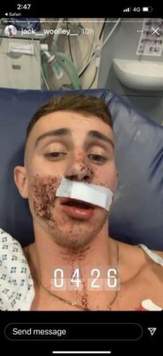 Impactantes imágenes: Ataque brutal a atleta olímpico gay que fue sometido a reconstrucción facial