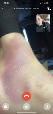 Lo que no se vio: La impactante foto del tobillo de Valverde y el festejo del Real Madrid en Anfield