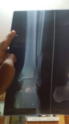 Vida: César Guillén se pierde el resto del torneo por fractura en el peroné