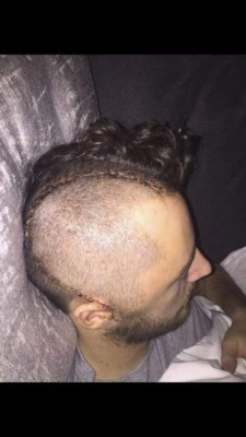 Escalofriantes: Las cicatrices más impactantes que han sufrido futbolistas y otros deportistas