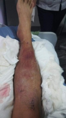 Las espeluznantes y temibles operaciones a los futbolistas