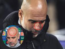 Pep Guardiola revela qué le pasó en la cara tras el Manchester City vs Feyenoord por la Champions League