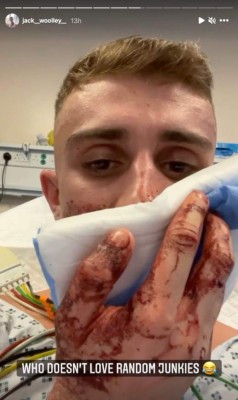 Impactantes imágenes: Ataque brutal a atleta olímpico gay que fue sometido a reconstrucción facial