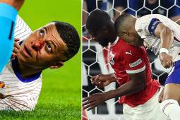 Kylian Mbappé terminó con la nariz fracturad en su debut con Francia en la Eurocopa.