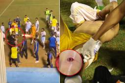Horror en Brasil: un policía le disparó con bala de goma a un futbolista y así le quedó la pierna
