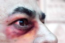 Un hombre de 56 años de edad es el primer caso de hongo negro en Honduras.