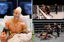 El estadounidense Sage Northcutt tuvo que pasar por el quirófano después de recibir el nocaut del brasileño Cosmo Alexandre.