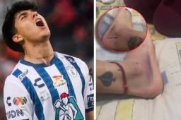 Figura del Pachuca se queja de los golpes que sufrió ante Motagua y saca a la luz sus heridas: “Y solo pitaron falta”