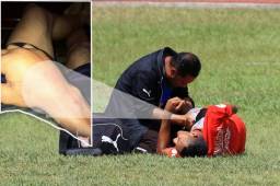 Así le quedó el brazo al delantero del Olimpia, Diego Reyes, cuando se lesionó el pasado viernes en la previa del partido de hoy contra Vida.