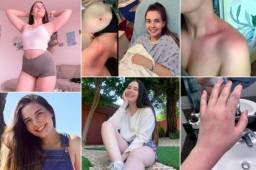 Tessa Hansen-Smith se ha vuelto tendencia en redes sociales y los medios le han dedicado su espacio ya que sufre de una rara enfermedad. Ella lo ha explicado todo a través de su cuenta de Instagram.