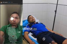 A Emilio Izaguirre se le introdujeron pequeños vidrios en el ojo durante el ataque a Motagua.
