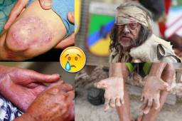 En varios estados de México se han detectado casos de lepra, una vieja enfermedad que puso de rodillas al mundo.