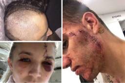 Son varios los futbolistas que han mostrado en redes sociales sus impactantes heridas. Estas sin duda son 'marcas de guerra'.