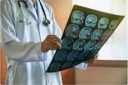 El coronavirus puede dañar el cerebro.