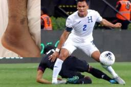 Así fue como se lesionó Denil Maldonado de un esguince grado tres donde se rompió los ligamentos pero no el hueso. Así tiene actualmente el tobillo. Fotos cortesía