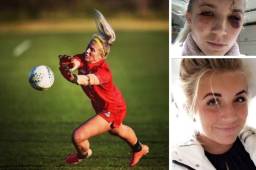 Frances Kitching, portera del Liverpool, sufrió un tremendo corte en la frente durante un entrenamiento. Prácticamente se abrió la cabeza y mostró en Instagram cómo quedó su rostro.