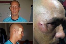 El asistente Gerson Matute terminó con una herida e hinchazón en su pómulo derecho.