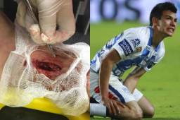 El Pachuca publicó en redes sociales como quedó el tobillo del jugador.