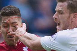 La impactante fotografía de la lesión de ojo de Roberto Firmino.