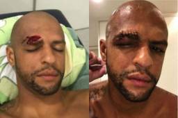 Felipe Melo mostró su lesión al término del partido.
