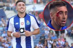 El mexicano Héctor Herrera sufrió un fuerte golpe en su nuevo rostro.