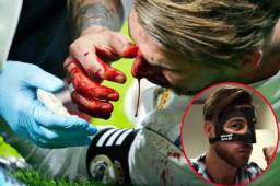Así le quedó el rostro a Sergio Ramos tras el choque con Lucas Hernández, jugador del Atlético de Madrid que lo hará usar máscara este fin de semana.