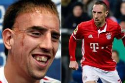 Frank Ribery nunca quiso borrarse la cicatriz de su rostro con cirugías porque afirmá le ayudó a formar su carácter.