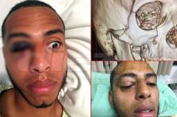 El delantero Eddie Hernández quedó con el rostro bastante dañado luego de impactar contra el defensor Caue Fernandes del Marathón. Fotos DIEZ