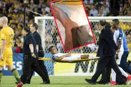 El hondureño Emilio Izaguirre mostró el terrible esguince que sufrió en el partido ante Australia y fue uno de los jugadores que más sintió la eliminación.