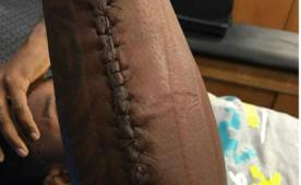 Thomas Davis jugó el Super Bowl con una protección en su brazo derecho.