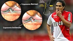 El delantero Radamel Falcao de 28 años de edad vive su peor pesadilla de lesión.