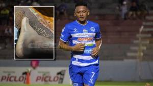 Alexy Vega se lesionó en el partido contra Olancho FC y regresará a las canchas hasta próximo torneo.