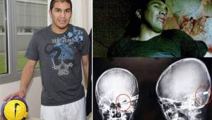 La madrugada del 25 de enero de 2010 Salvador Cabañas recibió un disparo en un baño de un bar en México y ha tenido que vivir con la bala alojada en su cráneo.