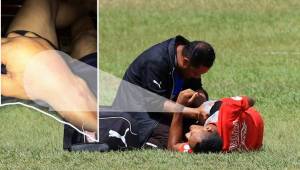 Así le quedó el brazo al delantero del Olimpia, Diego Reyes, cuando se lesionó el pasado viernes en la previa del partido de hoy contra Vida.