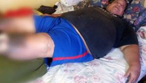 Rafael 'Paciencia' Núñez se encuentra postrado en cama y urge de la ayuda de todos para que no le amputen las piernas. Foto Cortesía