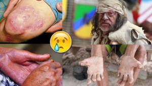 En varios estados de México se han detectado casos de lepra, una vieja enfermedad que puso de rodillas al mundo.