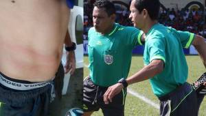 El árbitro asistente Rolando Vega, le mostró al comisario del partido la marca que le dejó la agresión del asistente técnico del Atlético Municipal.