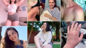 Tessa Hansen-Smith se ha vuelto tendencia en redes sociales y los medios le han dedicado su espacio ya que sufre de una rara enfermedad. Ella lo ha explicado todo a través de su cuenta de Instagram.
