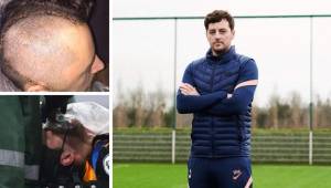 Ryan Mason estuvo al borde de la muerte, tiene 14 placas de metal en el cráneo sujetadas por 28 tornillos y 45 grapas. Ahora fue nombrado DT del Tottenham de la Premier League, tomando el lugar de Mourinho.