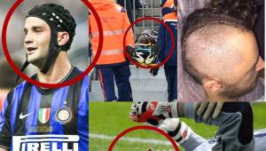 Inter de Milán, Wolverhampton, Chelsea y ahora Girondins de Burdeos tienen el aterrador dato de jugadores con fracturas de cráneo en un partido de fútbol. Acá te compartimos el listado.