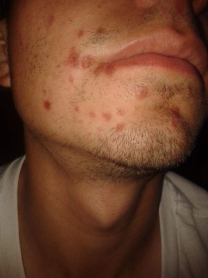 Nuevos síntomas del coronavirus: Las cinco manifestaciones que se producen en la piel&nbsp;&nbsp;