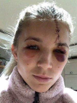 Escalofriantes: Las cicatrices más impactantes que han sufrido futbolistas y otros deportistas